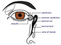 Tear duct obstruction