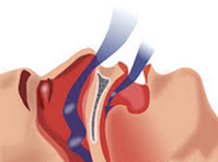 Snoring and sleep apnoea management