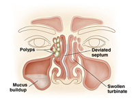 Allergy and sinus problems