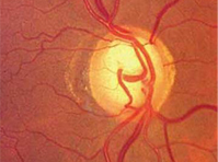 Pediatric glaucoma