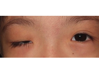Droopy eyelids